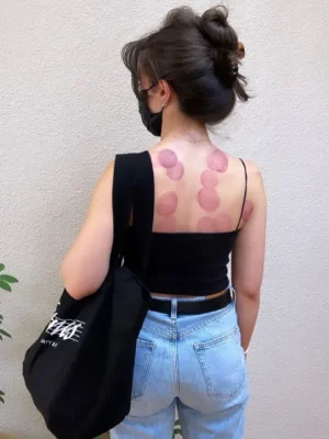 post-cupping-marks-on-back-fashionable-look-golden-spa.webp